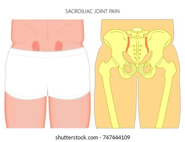 Vector illustration of unhealthy human pelvis with sacroiliac joint pain or injury.  For advertising and other medical publications. EPS 10