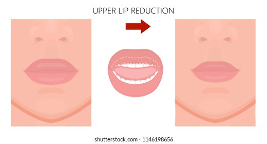 Vector illustration. Upper lip reduction before, after procedure. Close up view. For advertising of cosmetic plastic procedures; for medical and beauty publications. EPS 10.