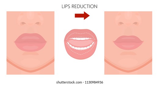 Vector illustration. Upper and lower  lip reduction before, after procedure. Close up view. For advertising of cosmetic plastic procedures; for medical and beauty publications. EPS 10.