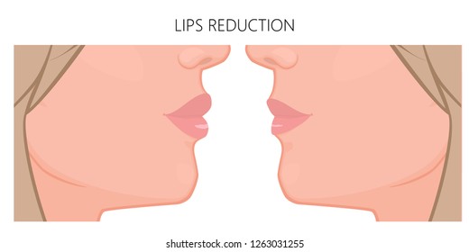 Vector illustration. Upper and lower  lip reduction before, after procedure. Close up view. For advertising of cosmetic plastic procedures; for medical and beauty publications. EPS 10.