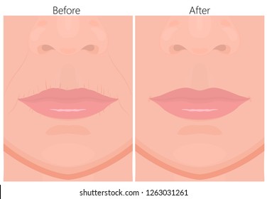 Vector illustration of upper-lip wrinkles removal before and after plastic surgery or cosmetic procedure. For advertising and beauty publications. EPS 10.