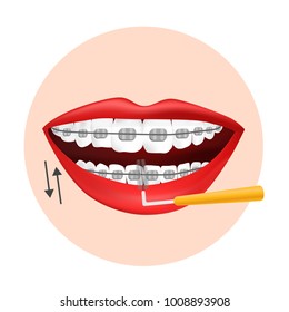 Vector illustration. Using interdental brush for orthodontic braces