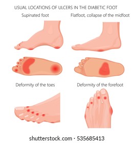 Vector illustration of usual locations of ulcers in the diabetic foot. Used: gradient, transparency, blend, blend mode.