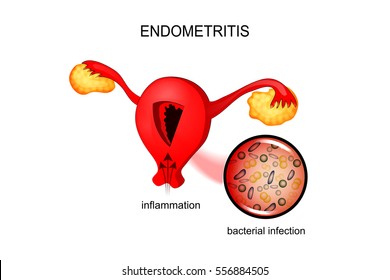 vector illustration of a uterus affected by endometriosis. for medical publications