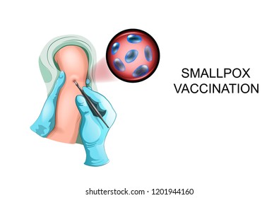 vector illustration of vaccination of a child against smallpox