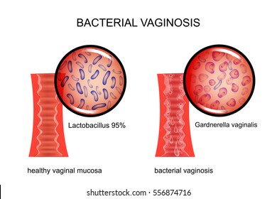 vector illustration of the vagina affected by bacterial vaginosis. for medical publications
