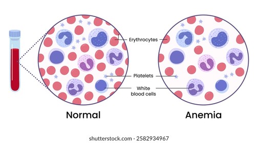 Vector illustration of the variation in the number of healthy erythrocytes in the blood. Anemia and normal.