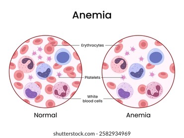Vector illustration of the variation in the number of healthy erythrocytes in the blood. The anemia and the norm.	