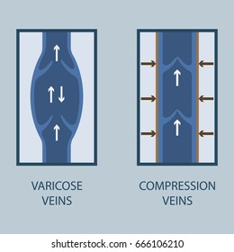 Vector illustration of a varicose vein and compression vein. Flat style.