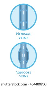 Vector illustration of a varicose vein and normal vein.