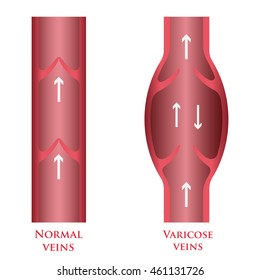 Vector illustration of a varicose vein and normal vein.