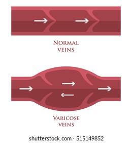 Vector illustration of a varicose vein and normal vein. Flat style. Varicose vein icon. 