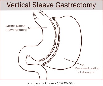 Vector illustration of Vertical Sleeve Gastrectomy