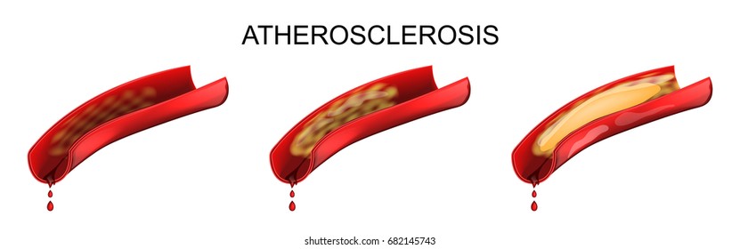 vector illustration of a vessel affected by atherosclerosis