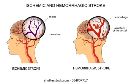 vector Illustration of the vessels of the brain and a brief description of the causes of stroke