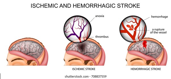 vector illustration of the vessels of the brain and a brief description of the causes of stroke