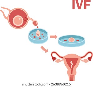 Vector illustration of In vitro fertilization IVF