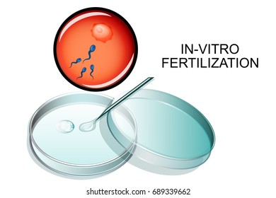 vector illustration of in vitro fertilization. IVF