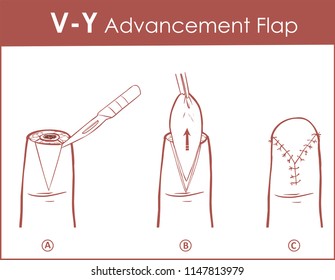 Vector illustration of a V-Y advancement flap