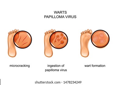 vector illustration of warts on the sole