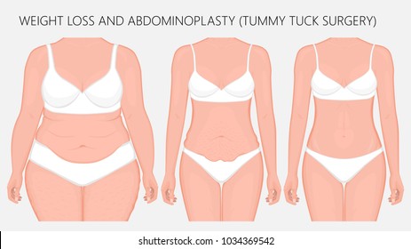 Vector illustration. Weight loss, abdominoplasty, tummy tuck plastic surgery in woman. Front view. For advertising of cosmetic plastic procedures, stomach shunting, diet; medical publications. EPS 8.