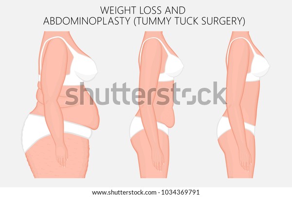 ベクターイラスト 痩せ 腹形成術 女性のおなかの整形手術 側面図 美容整形法 胃シュント 食事の宣伝医学関連の出版物 Eps 8 のベクター画像素材 ロイヤリティフリー