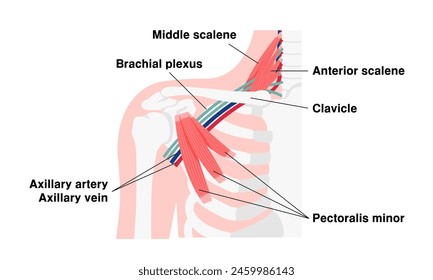 Ilustración vectorial de dónde se produce el síndrome de la salida torácica