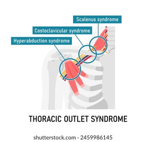 Vector illustration of where thoracic outlet syndrome occurs