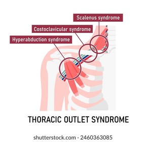 Vektorillustration des Auftretens des Thoracic-Outlet-Syndroms