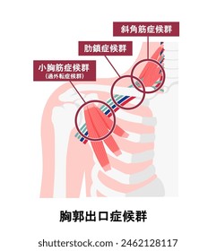 Vector illustration of where thoracic outlet syndrome occurs. Translation: Thoracic outlet syndrome,  Scalenus-syndrome, Costoclavicular-syndrome, Hyperabduction-syndrome.
