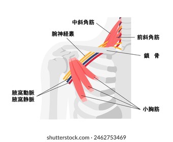 Vector illustration of where thoracic outlet syndrome occurs. Translation: Middle scalene, Anterior scalene, Clavicle, Brachial plexus, Axillary artery, Axillary vein,  Pectoralis minor.