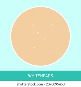 Vector illustration "Whiteheads". Close up skin image with whiteheads. Colorful image for medical articles, posters and banners.