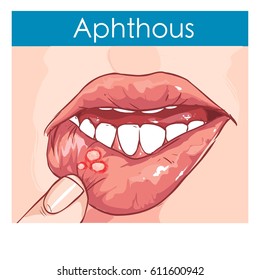  Vector Illustration Of A Woman With Aphthae On Lip.