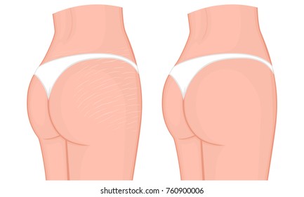 Vector illustration of a woman body problem. Stretch marks on European, Asian female thighs and lower back. For advertising, medical publications, use on package of medicinal products, creams. EPS 8.