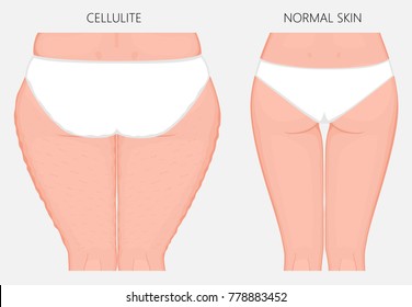 Vector illustration of woman body problem. Cellulitis on European, Asian female thighs, weight loss and normal skin. For advertising of anti cellulite procedures, medical publications, creams. EPS 8.