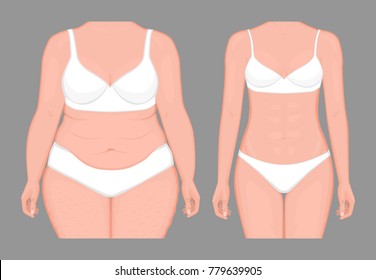 Vector illustration. Woman body problem fat belly in European Asian female, weight loss to normal slim figure. Front view. For advertising of cosmetic plastic procedures, medical publications. EPS 8