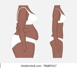 Vector illustration. Woman body problem obese, in African American female, weight loss to normal slim figure. Side view. Advertising of cosmetic plastic procedures,  diet, medical publications. EPS 8.