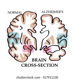 Vector illustration for World Alzheimer's Day, September 21. Fight Alzheimer's Disease.