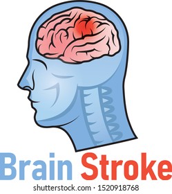 2,387 Brain bleeding Images, Stock Photos & Vectors | Shutterstock