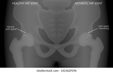 Vector illustration x-ray of human healthy hip and pain in arthritic hip joint, narrowing joint space. For advertisement and medical publications.