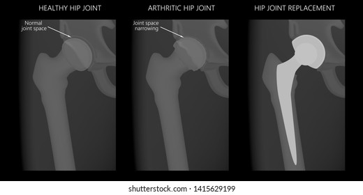 Vector illustration x-ray of human pelvis, Healthy hip, arthritic hip joint and total hip replacement. For advertisement and medical publications.