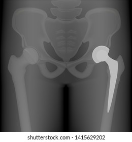 Vector illustration. X-ray of human total hip replacement. For advertisement and medical publications.