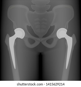 Röntgen-Röntgen-Vektorillustration Pelvis und Hip-Gelenk, Bilateraler Hüftersatz. Für Werbung und medizinische Publikationen.