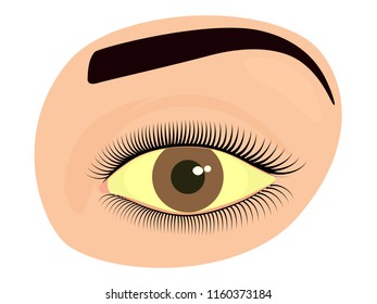Vector illustration of a yellowed human eye as a symptom of hepatitis. For advertisement of drops and other medications, for medical publications. EPS 10.