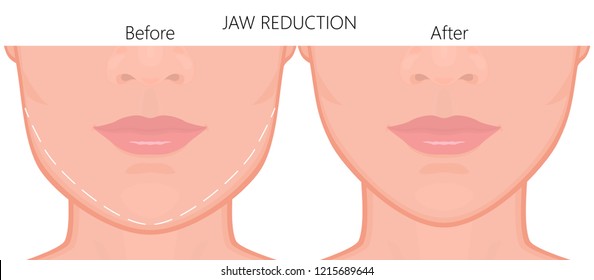 Vector Illustration. A Young White Female Face Before And After Plastic Surgery - Jaw Reduction. Close Up View. For Advertising Of Plastic Surgery, Medical And Beauty Publications. EPS 10.