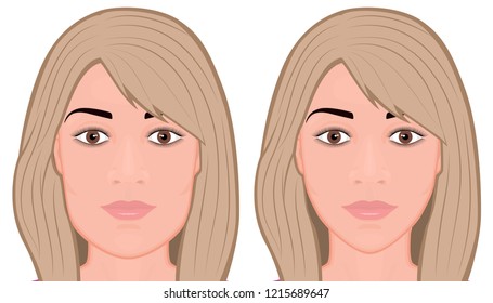 Vector illustration. A young white female face before and after plastic surgery - jaw reduction. Frontal view. For advertising of plastic surgery, medical and beauty publications. EPS 10.