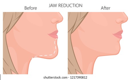 Vector illustration. A young white female face before and after plastic surgery - jaw reduction. Close up view. For advertising of plastic surgery, medical and beauty publications. EPS 10.