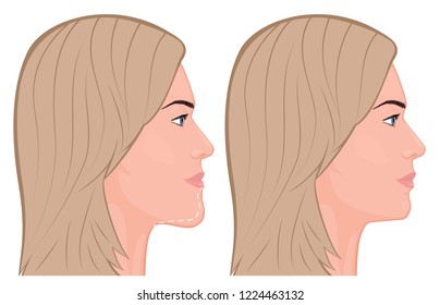 Vector illustration. A young white female face before and after plastic surgery - jaw reduction. Face profile. For advertising of plastic surgery, medical and beauty publications. EPS 10.