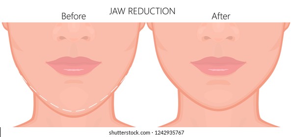 Vector illustration. A young white female face before and after plastic surgery - jaw reduction. Close up view. For advertising of plastic surgery, medical and beauty publications. EPS 10.