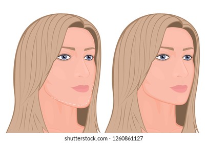 Vector illustration. A young white female face before and after plastic surgery - jaw reduction. Half-turned head. For advertising of plastic surgery, medical and beauty publications. EPS 10.